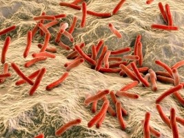 Haïti - Santé : Premier cas de lèpre au Chili diagnostiquée chez un patient haïtien