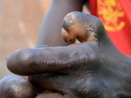 Haïti - Santé : 50 nouveaux cas de lèpre au pays