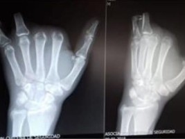 Haiti - Chile : A Haitian pursues his employer for 271 million pesos