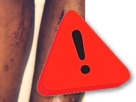 Haïti - ALERTE : Une infection très contagieuse détectée dans plusieurs zones du pays